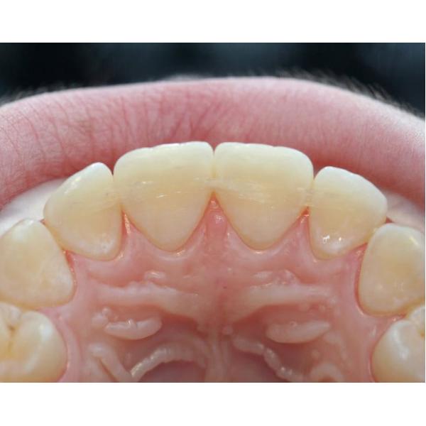 Dentapreg SFM - 5 pásek 6 cm