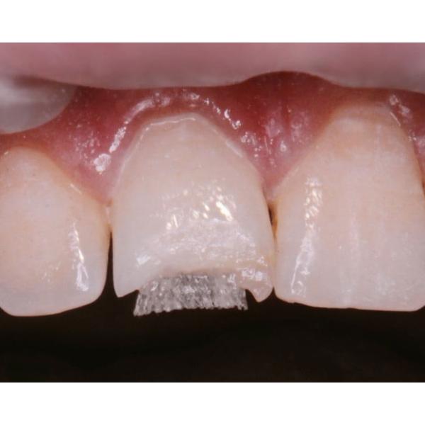 Dentapreg Bridge UFM - 6,0x0,1mm 1 ks