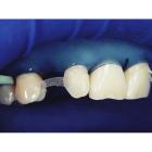 Dentapreg Bridge PFM 3,0x0,3mm 3 ks
