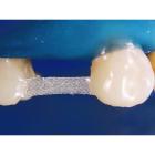Dentapreg Bridge PFM 3,0x0,3mm 3 ks